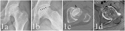 The Value of the Frog Lateral View Radiograph for Detecting Collapse of Femur Head Necrosis: A Retrospective Study of 1001 Cases